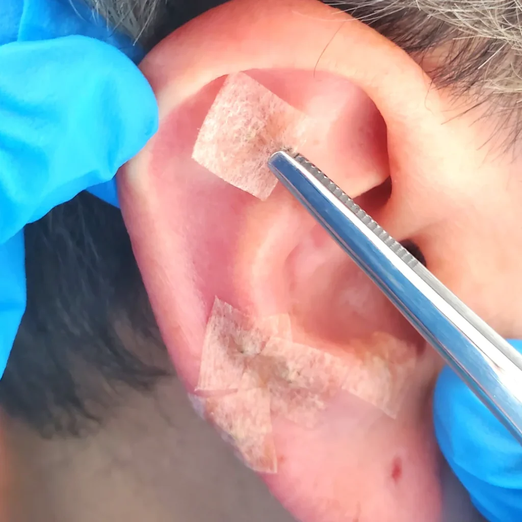 auriculoterapia en bogota
