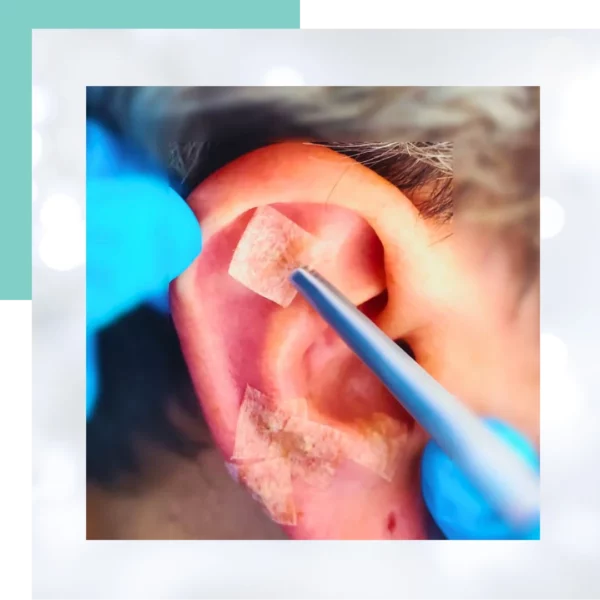 auriculoterapia en bogota
