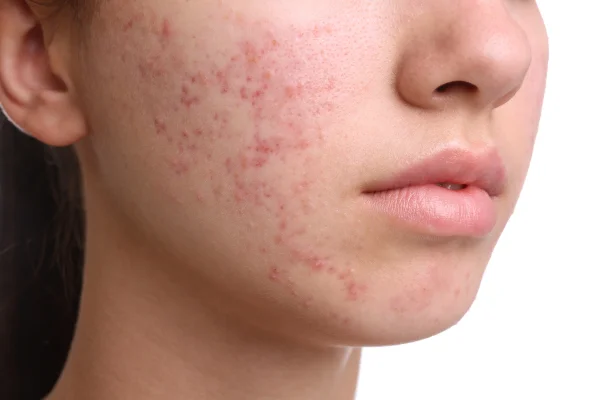 que es el acne y remedios naturales
